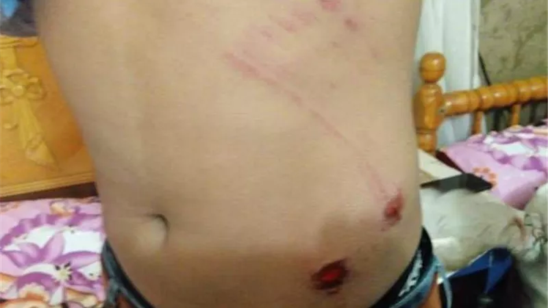 الكلاب الضالة تعقر طفلا فى العيد بسفاجا وتحرير محضر بالواقعة ..صور