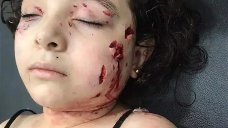 كلب مفترس يهاجم طفلة ويشوه وجهها فى مدينة المستقبل.. بالفيديو
