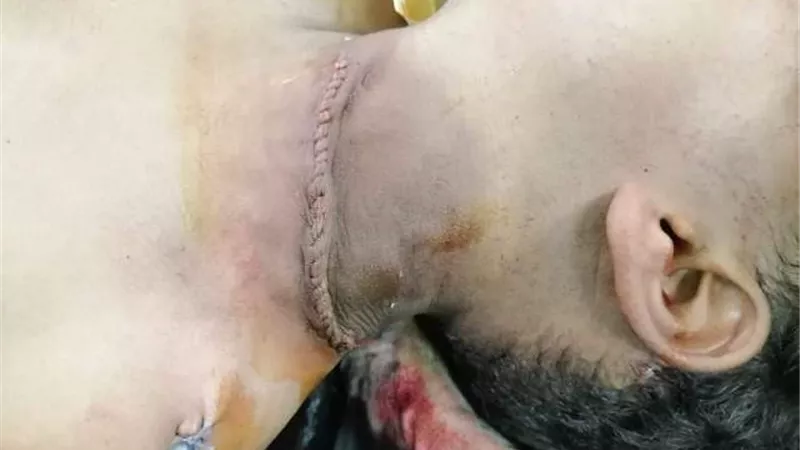 استئصال ورم خلقى بالرقبة لطفل عمره 8 سنوات بمستشفى أسوان الجامعي ..صور