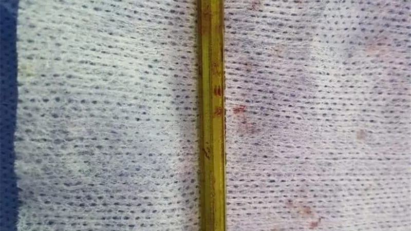 مستشفي سوهاج الجامعي تنجح في استخراج مفك طوله ١٠ سم من رأس مواطن..صور