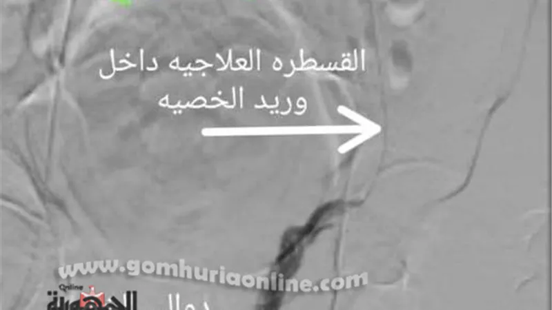 مستشفي سوهاج الجامعي تجري أول قسطرة علاجية لعلاج دوالي الخصية بدون جراحة..صور