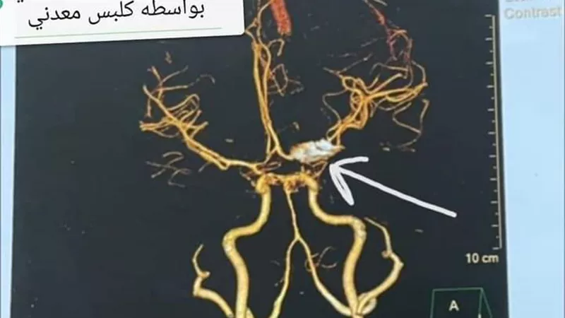 مستشفي سوهاج الجامعي تجري 5 عمليات ميكروسكوبيه لعلاج التمددات الشريانية