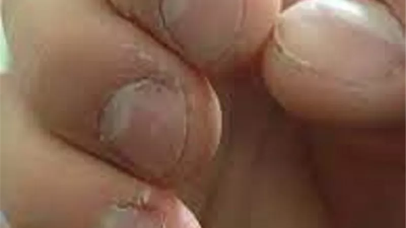 ما حكم من قضم ظفرًا من أظافره ناسيًا وهو محرم؟