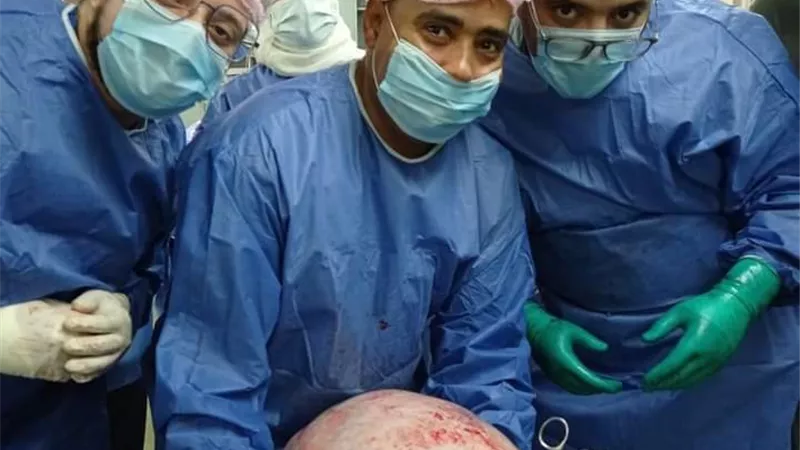 مستشفي سوهاج الجامعي ينجح فى استئصال ورم يزن ١٥ كجم من فتاة فى العشرين من عمرها