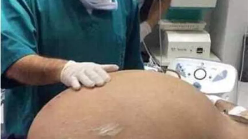 لأول مرة .. استئصال ورم في تجويف البطن بتقنية الهايبك في الإسماعيلية التعليمي