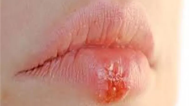 يصيب النساء أكثر .. اعراض الفيروس الهربس