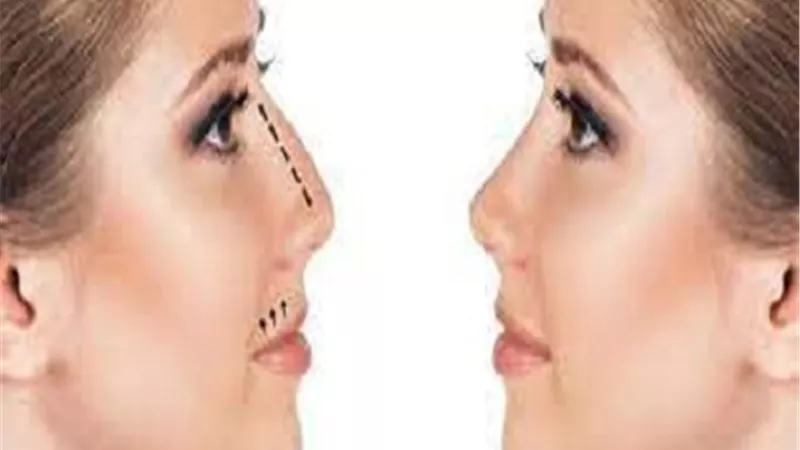 بالفيديو.. استشاري: تجميل الأنف ممكن بدون تدخل جراحي