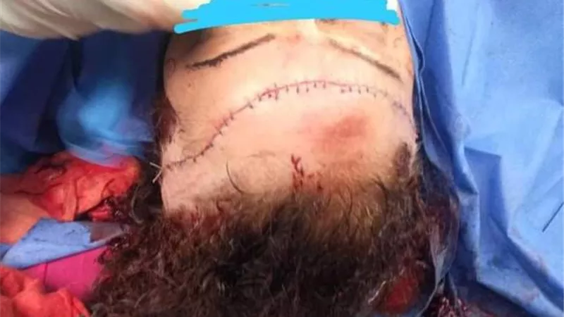 اعادة فروة رأس سيدة مصابة بجروح قطعية علي محيط رأسها في مطروح