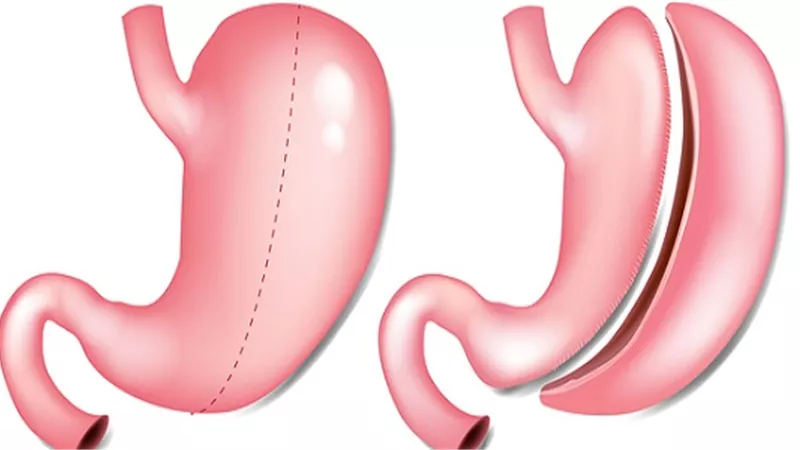 بالفيديو.. استشاري: عملية تكميم المعدة تُعالج السكر الخفيف