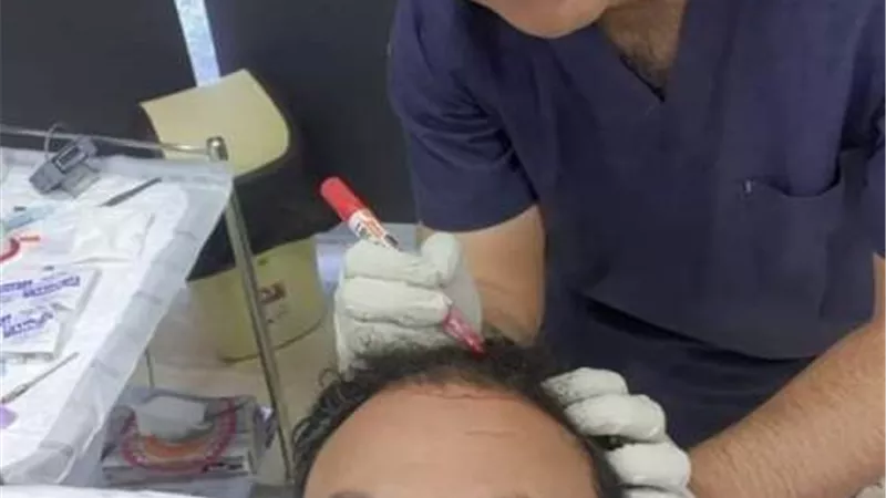 عملية زرع شعر لمراد مكرم