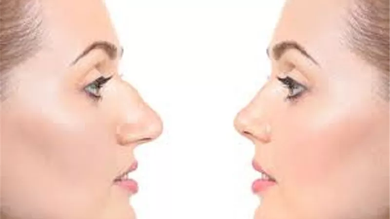 ما حكم إجراء عملية لتصغير الأنف؟.. دار الإفتاء تجيب
