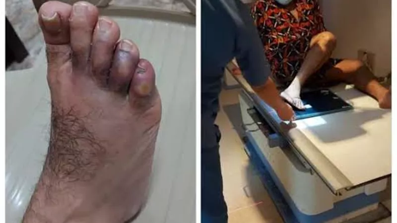 إصابة فنان شهير بعد سقوط قطعة الديكور على قدمه