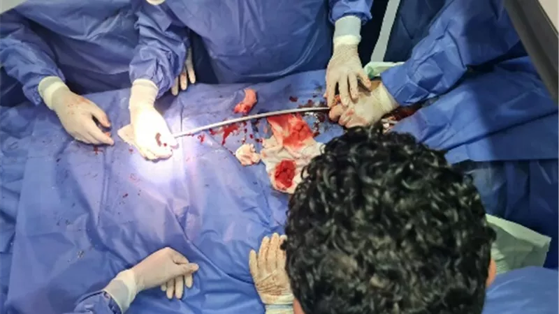 نجاح عملية قسطرة تداخلية طرفية لـ