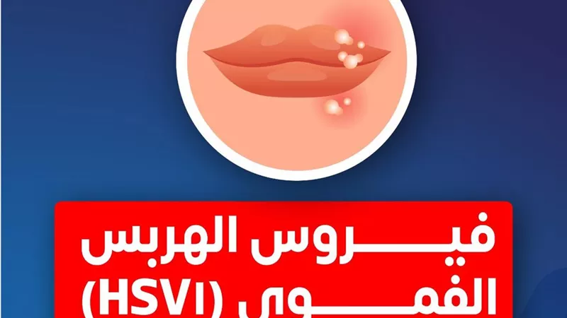 نصائح لوقاية الأطفال من فيروس الهربس الفموي