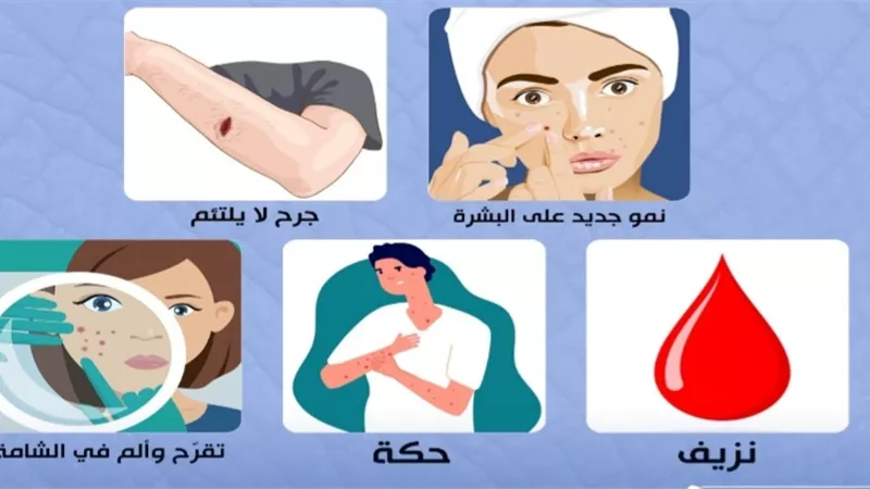 دليل للتشخيص الذاتي لسرطان الجلد.. انفوجراف