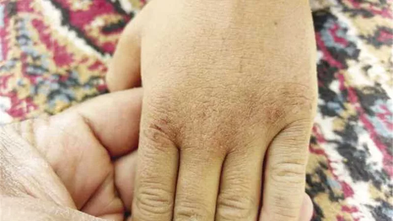 4 نصائح لحماية الجلد من التشققات
