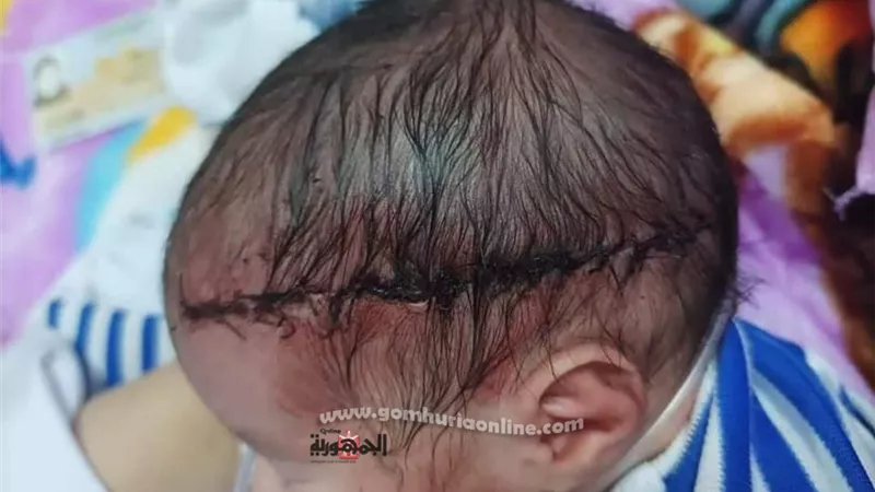 اصابة مولود بجرح قطعى فى الرأس اثر خطأ طبى أثناء عملية ولادة قيصرية فى العاشر من رمضان