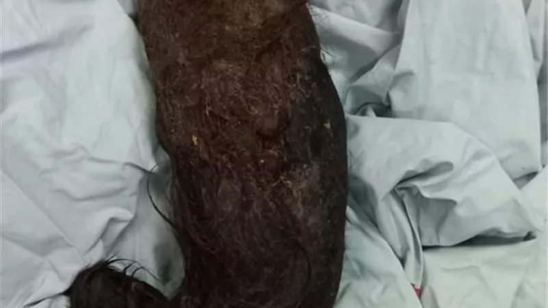فريق جراحي يكتشف مفاجأة داخل معدة مريضة في لبنان.. صور