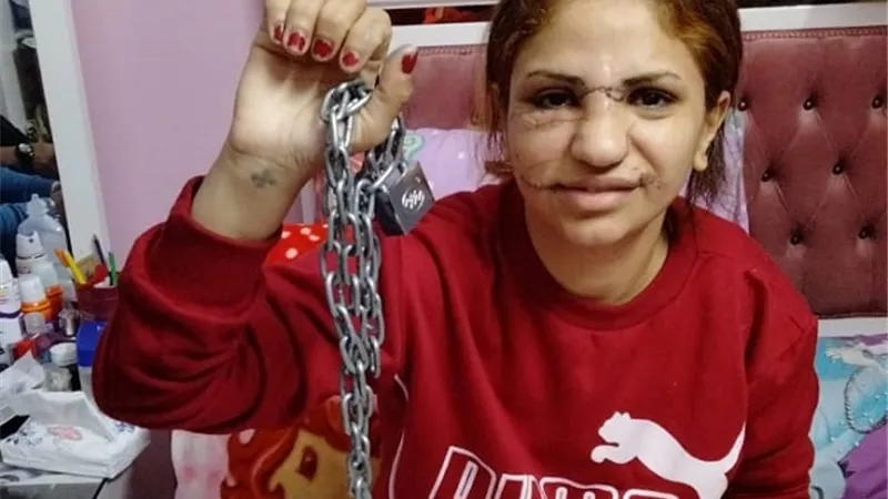 زوج يشوه وجه زوجته ب 165 غرزة بالوراق..بالفيديو