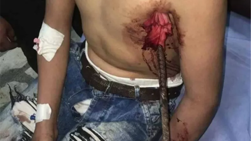 فريق جراحى بجامعة طنطا يتمكن من استخراج سيخ حديدى نافذ لطفل من الصدر للرقبة