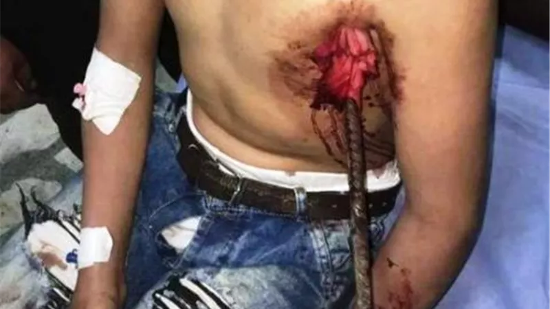فريق جراحى بجامعة طنطا يتمكن من استخراج سيخ حديدى نافذ لطفل من الصدر للرقبة