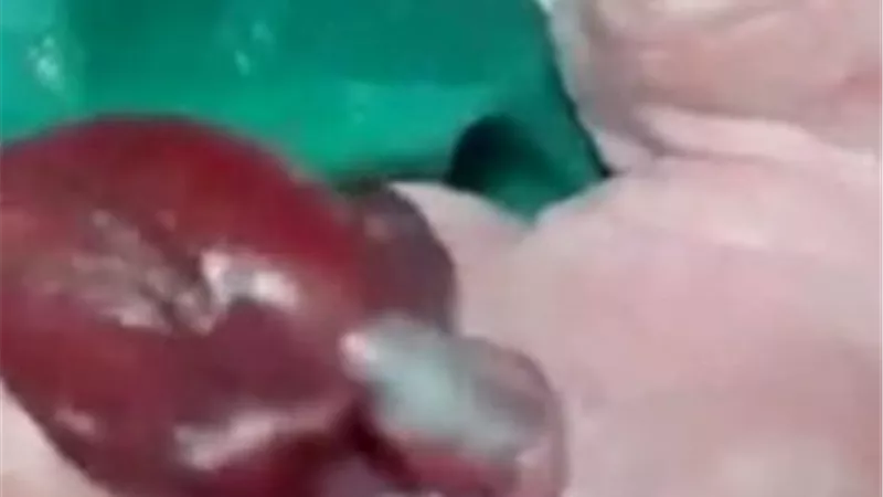 سيدة بطهطا بسوهاج تضع 3 توائم بينهم طفلة قلبها خارج جسدها