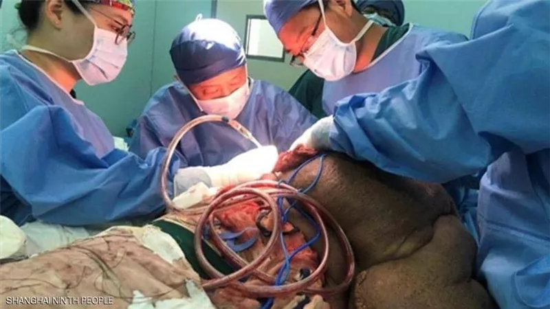 33 ساعة لإنقاذ رجل من ورم سرطاني وزنه 28 كيلوغراما.. صور