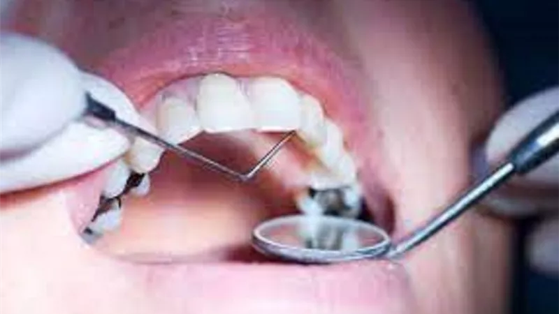 أسباب تسوس الأسنان وطرق الوقاية منها؟