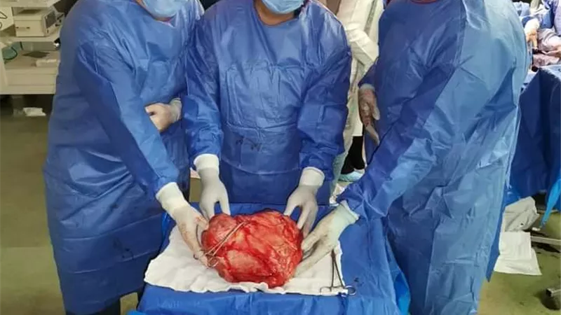 فريق طبي بمستشفي سوهاج الجامعي ينجح فى استئصال ورم يزن ١٨ كجم من شاب ثلاثيني