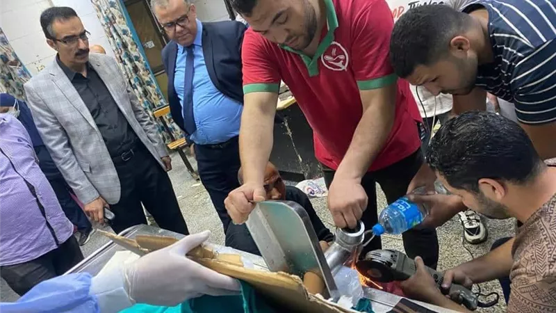 طوارئ المنصورة تجرى جراحة نادرة لطفل انزلقت يداة داخل مفرمة لحم
