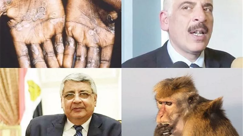 جدري القرود مرض محدود .. ومن السهل السيطرة عليه