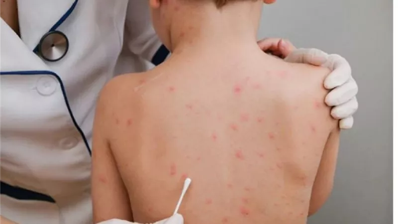 روسيا تطالب بالتحقيق في نشاط 4 مختبرات بيولوجية أمريكية في نيجيريا حيث نشأ 