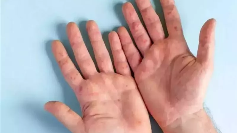 أستاذ أوبئة يكشف طرق العدوى بأنفلونزا الطماطم وماهو العلاج المناسب