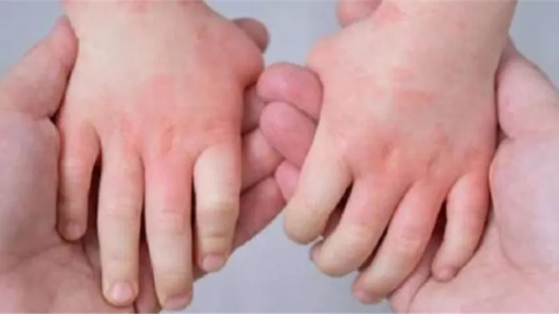 سمعت عن أنفلوانزا الطماطم؟.. تعرف معنا على المرض الجديد ومدى خطورته وطرق مواجهته