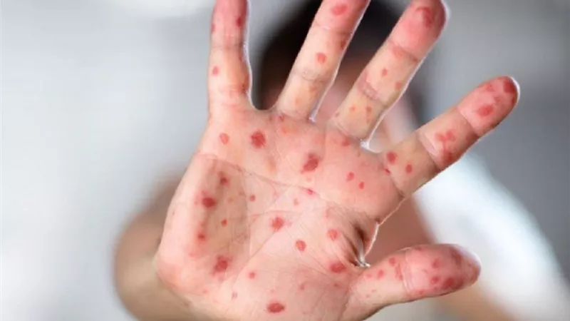 نيجيريا تسجل 31 إصابة بجدري القردة منذ بداية العام