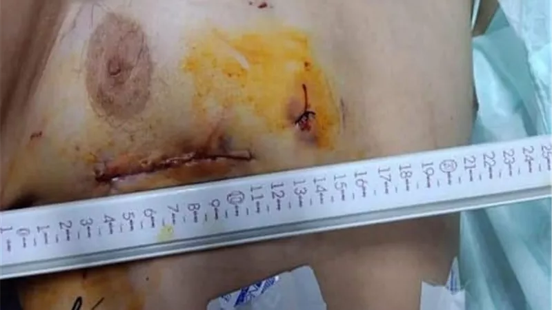 الأولى من نوعها .. إجراء جراحة زراعة الصمام الميترالي بالمنظار بمستشفيات بنها الجامعي