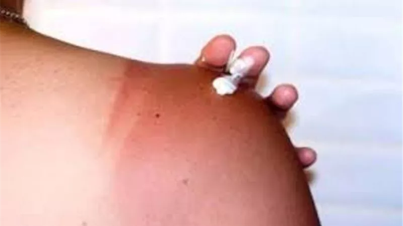 مخاطر وطرق الوقاية من حروق الشمس