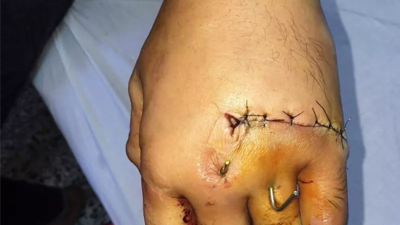 جراحة نادرة استمرت 6 ساعات لتوصيل كف يد بعد بترها بطوارئ المنصورة