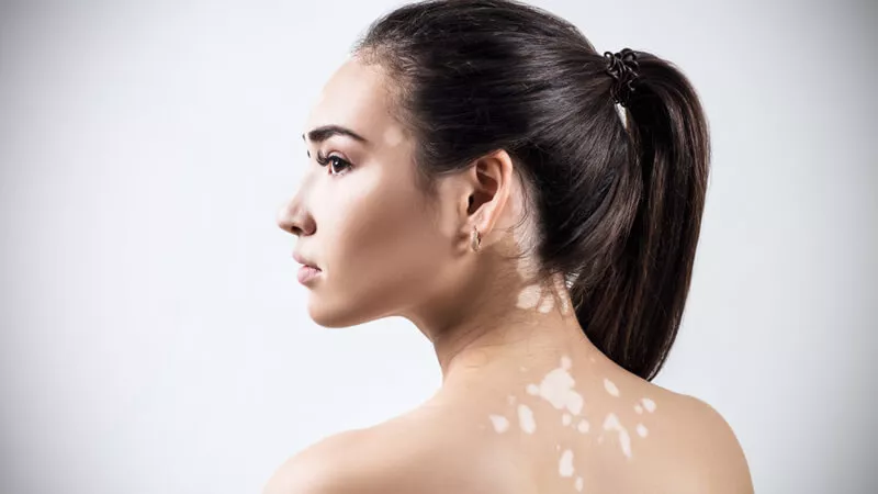 أول دواء منزلي لمرضى البهاق يعيد الجلد لطبيعته