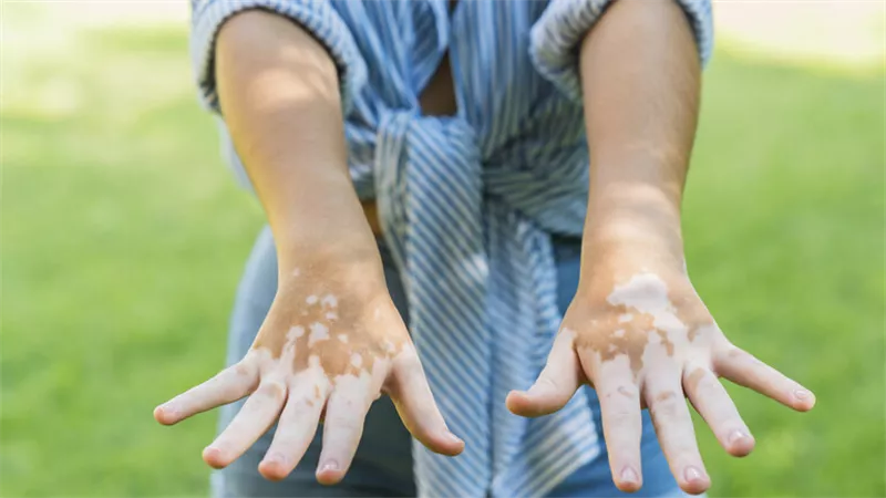 أول علاج للبهاق يعيد الجلد إلى طبيعته في غضون 24 أسبوعا