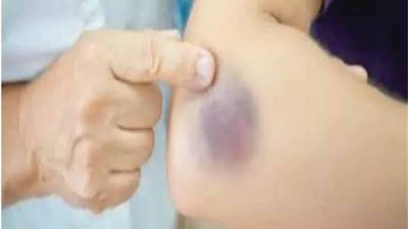 بتعانى من ظهور كدمات مجهولة على الجلد..اعرف السبب