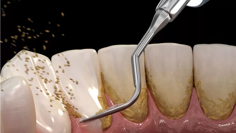 أضرار تنظيف الأسنان