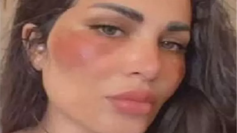 تفاصيل تعرض طليقة احمد الفيشاوى للحريق