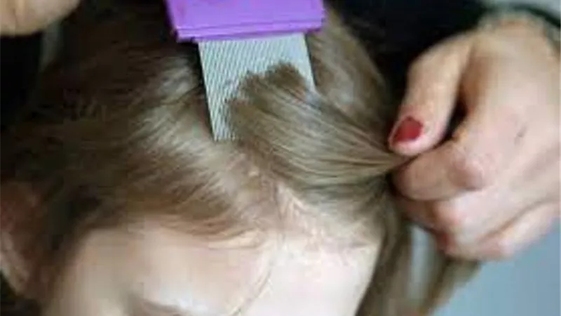 علاج حشرات رأس طفلك طبيا ومنزليا