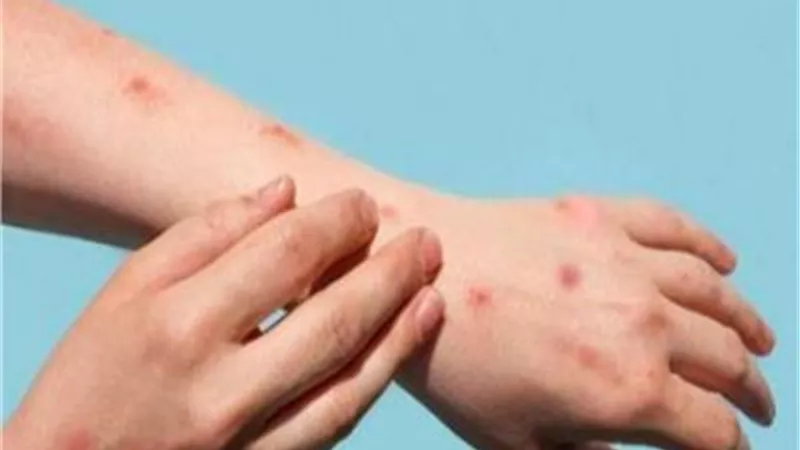 إصابة رجل بجدري القردة بسبب اختلاط 