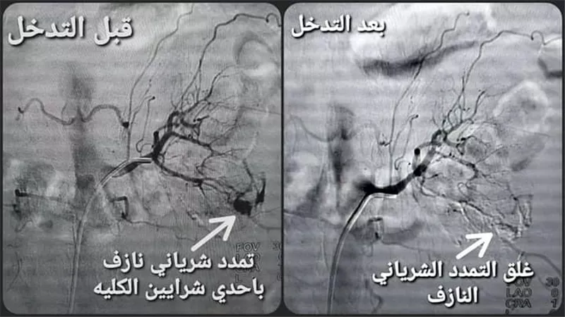 فريق طبي بمستشفي سوهاج الجامعي ينجح في إنقاذ مريضة تعاني من نزف حاد بالكلي