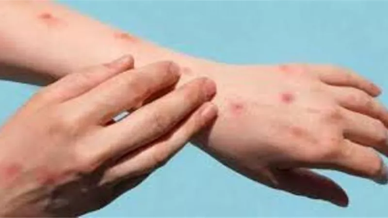 نيويورك تعلن أول حالة إصابة بجدرى القرود
