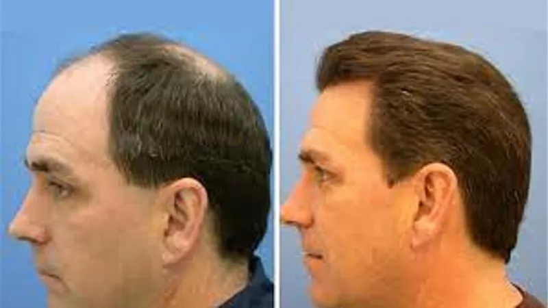 حكم زراعة الشعر للرجال