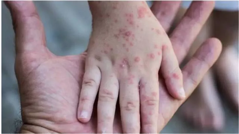 الولايات المتحدة تجري تجارب أولية لاستخدام عقار في علاج 