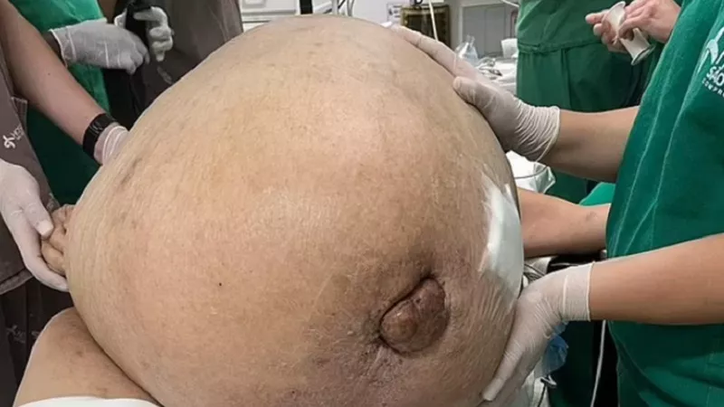 إزالة ورم بوزن 45 كيلوجراما من جسم امرأة .. صور